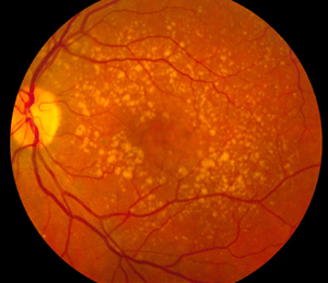 Macular degeneration